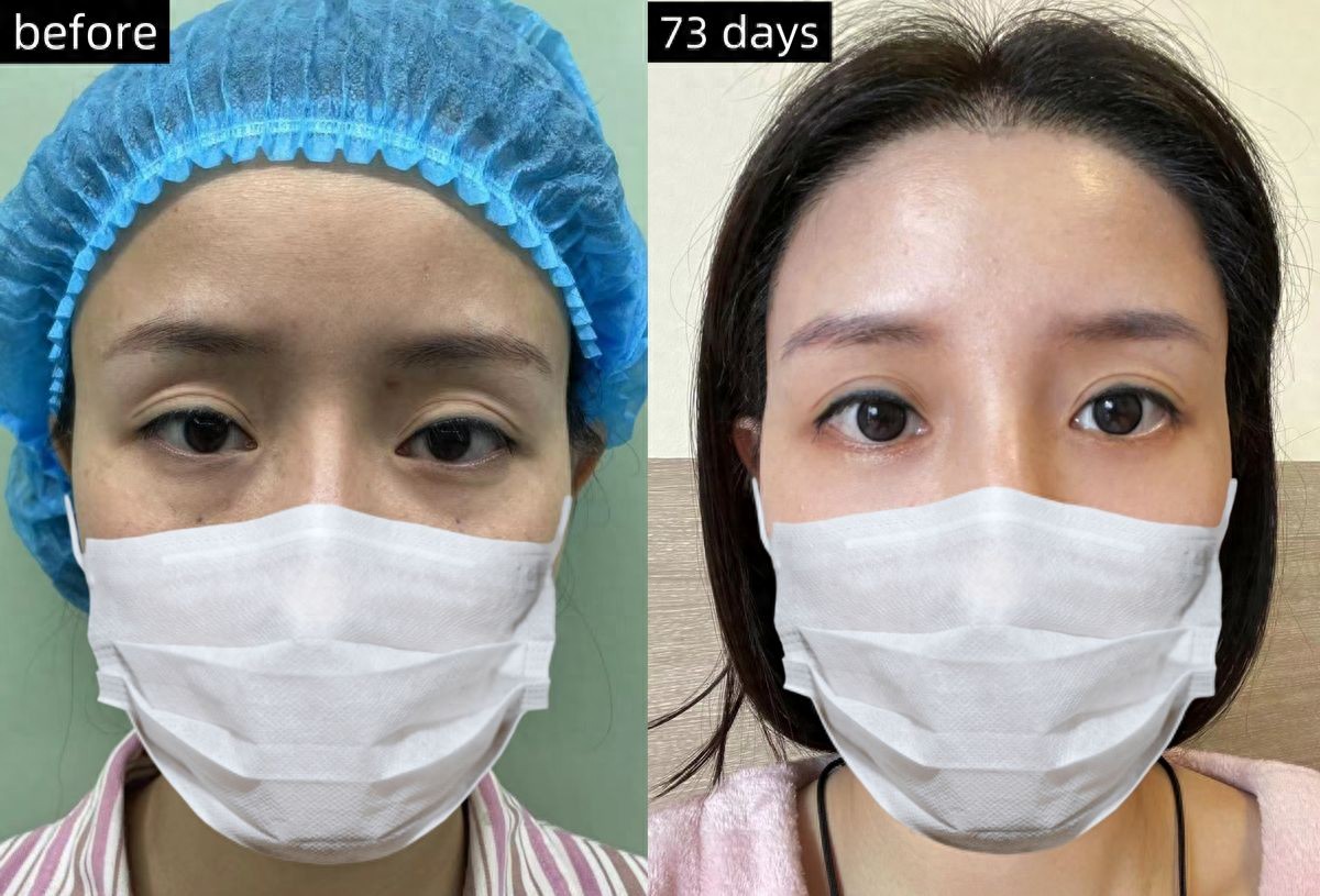 被姐姐安利膨体泪沟，术后一个月惊艳亲友，都说我看着像大学生